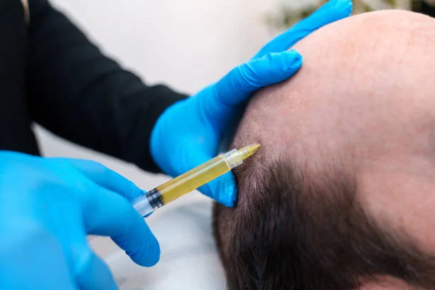 PRP Hair Restoration