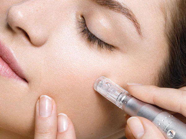 RF microneedling