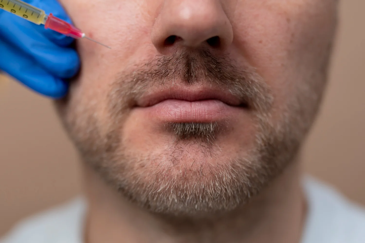 PRP Beard Growth: A Natural Solution for Thicker Facial Hair